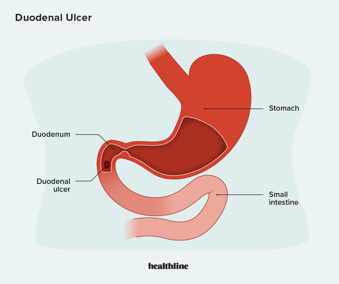 Where Does Duodenal Ulcer Pain Hurt? Key Locations