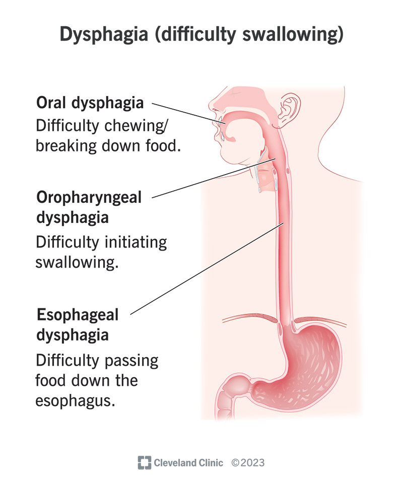 Esophageal Dysphagia Treatment: What Works and What to Expect