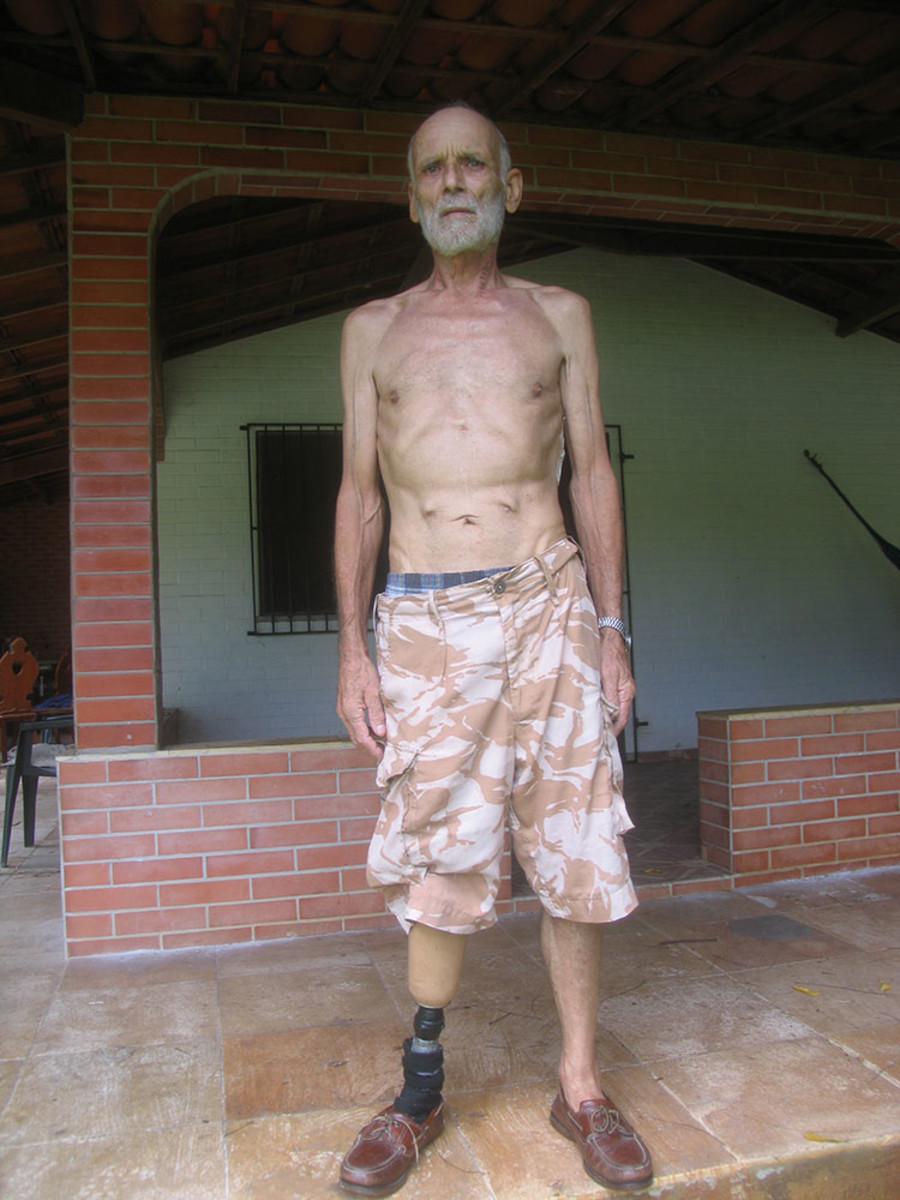 Esophagectomy Recovery Stories: Real Hope and Honest Journeys