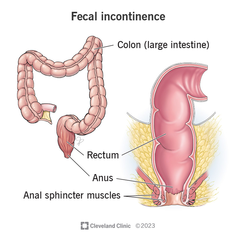 How to Get Rid of Old Feces in Colon: Safe & Natural