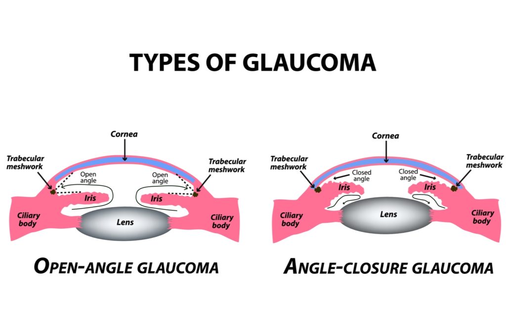 Is Glaucoma Hereditary? What You Need to Know Today