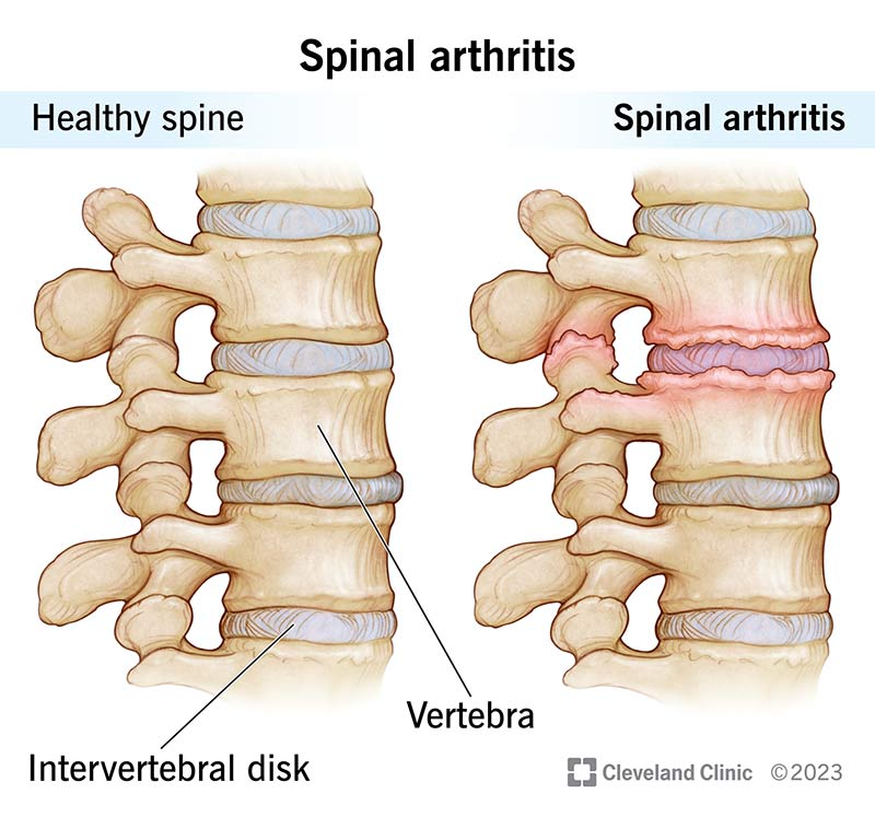 Is Inflammation of the Spine Serious? Quick Answers