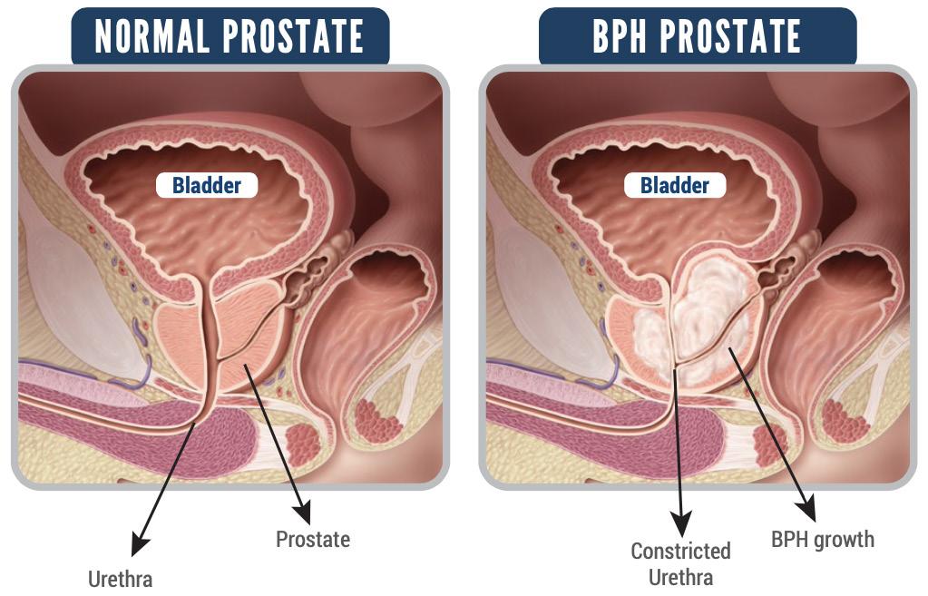 Minimally Invasive Prostate Surgery: Key Facts