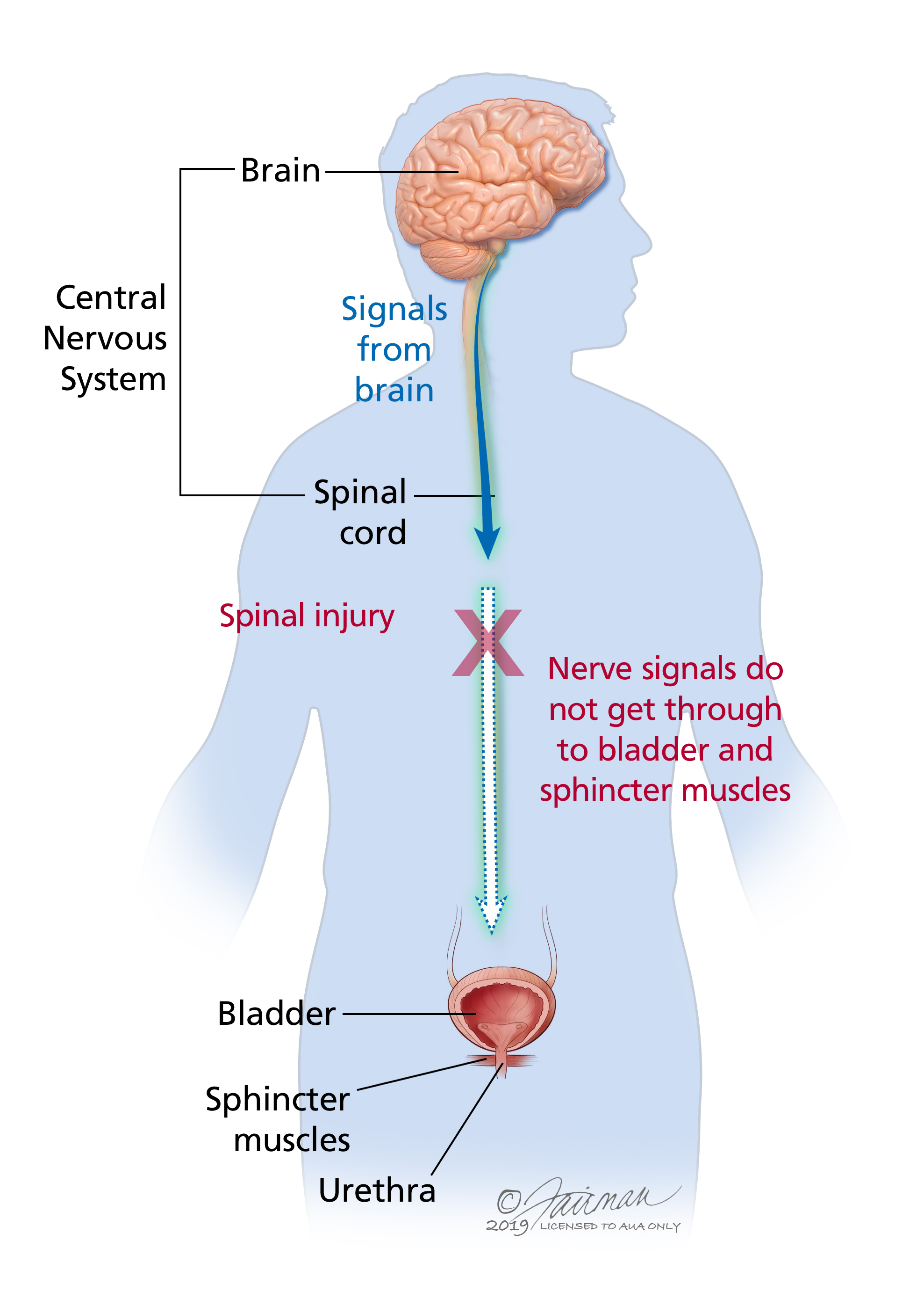 Parkinson’s Neurogenic Bladder: Managing Symptoms