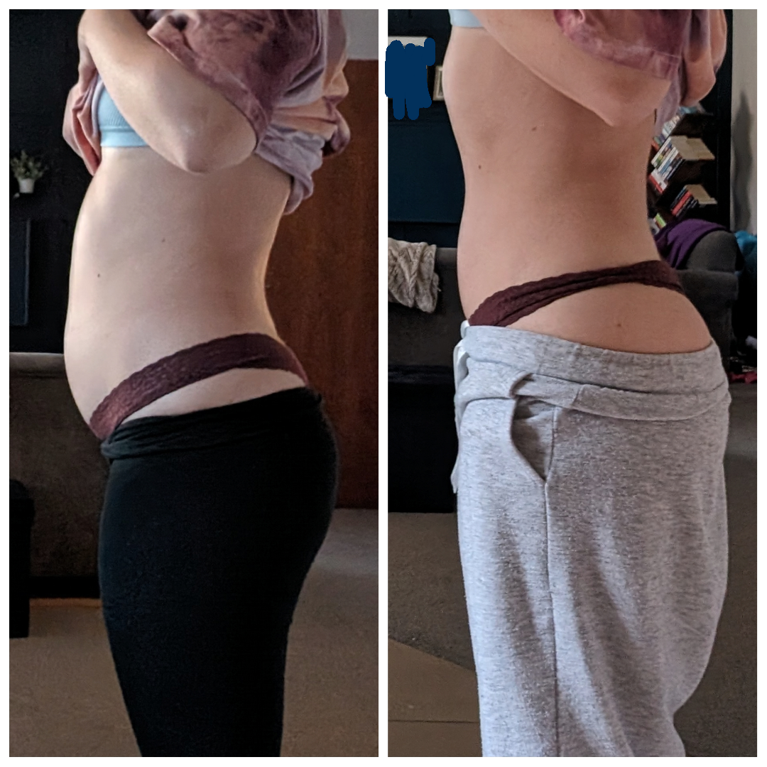 PCOS Bloating Reddit: Real Tips, Remedies & Relief