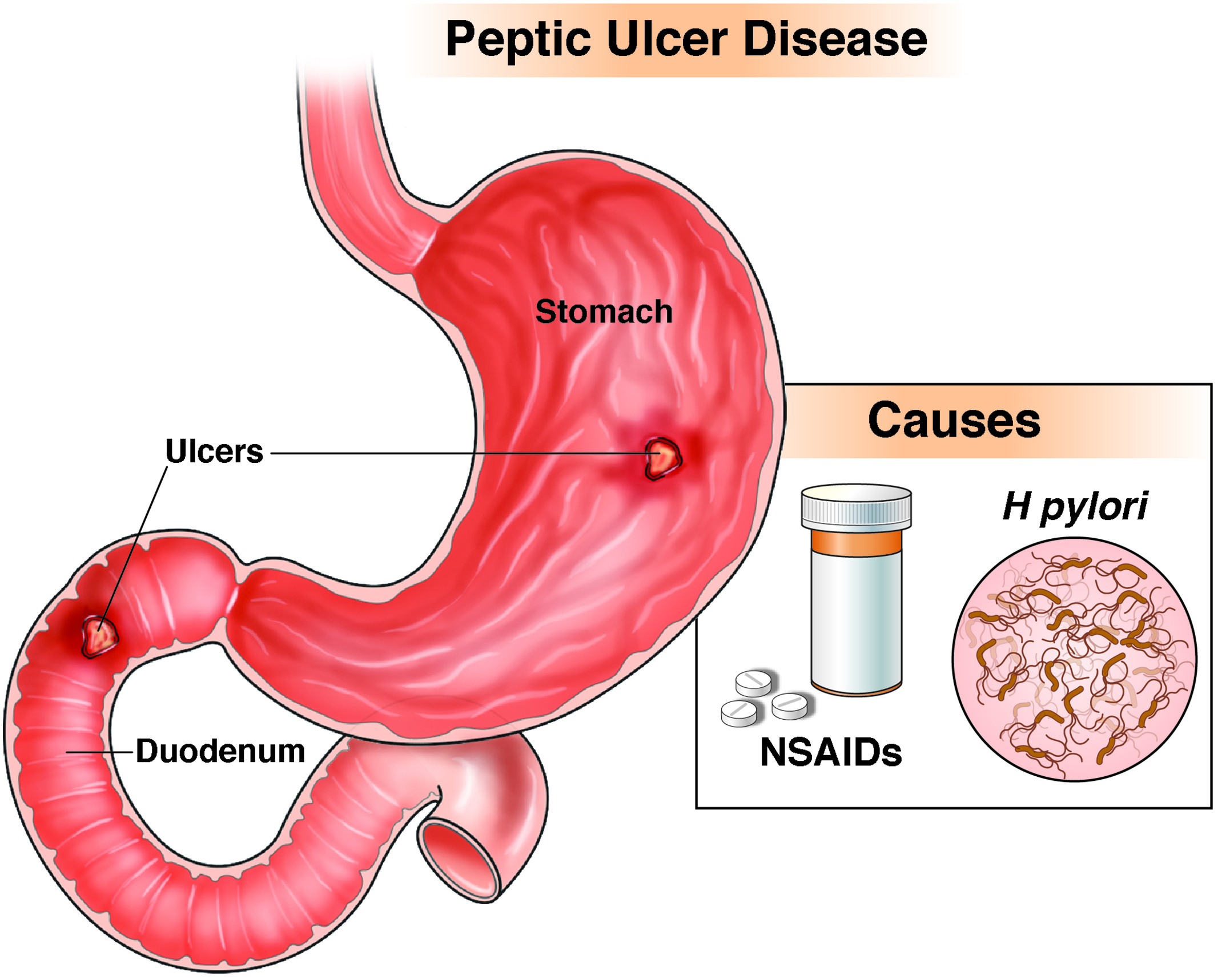 Prepyloric Ulcer ICD-10: Quick Code Guide & Why It Matters
