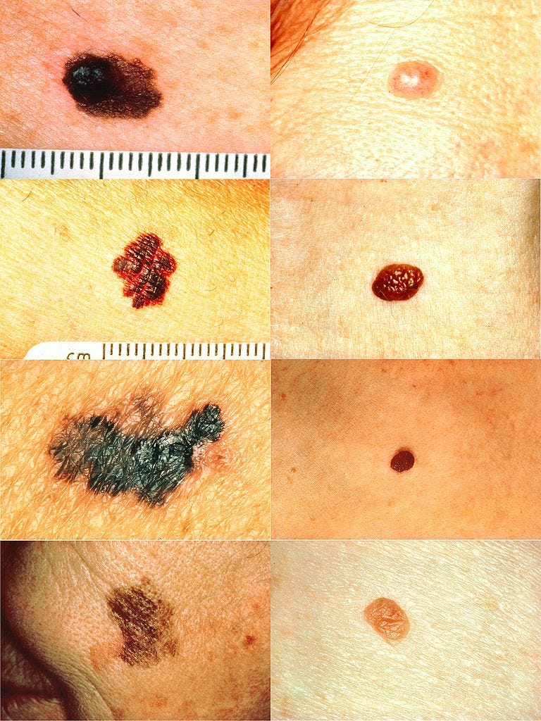 Skin Moles to Worry About: A Simple, Friendly Guide