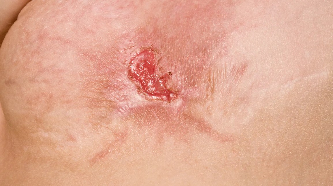 Skin Sores That Won’t Heal – Causes, Risks & What To Do