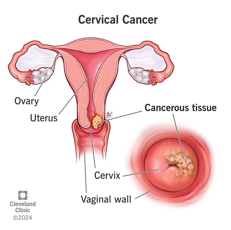 Stage 1 Cervical Cancer Symptoms: Early Warning Signs