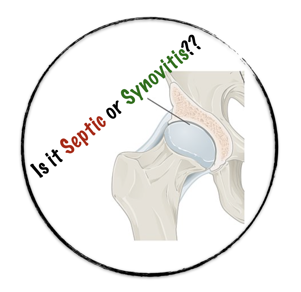 Transient Synovitis in Adults: Fast Relief Guide