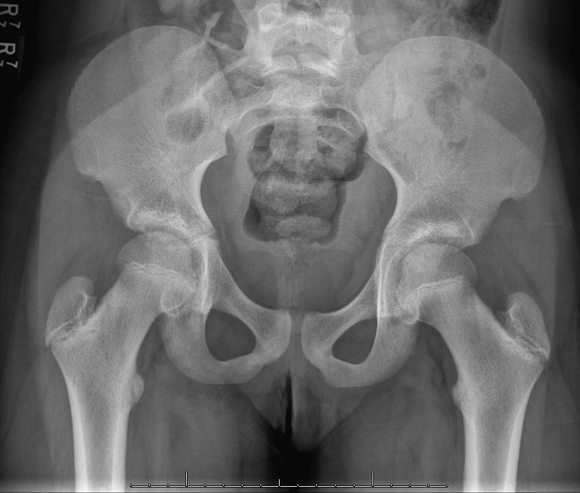 Transient Synovitis of Hip in Child: Quick Care Guide