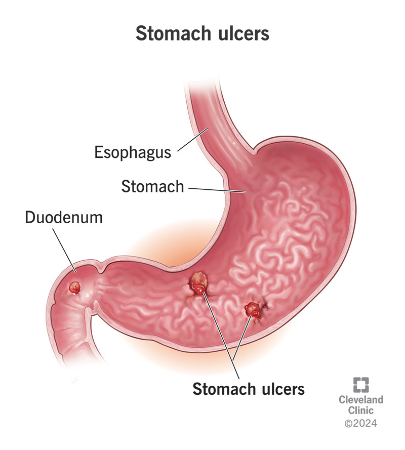 Treatment for Stomach Ulcer: Fast, Safe, Proven Options