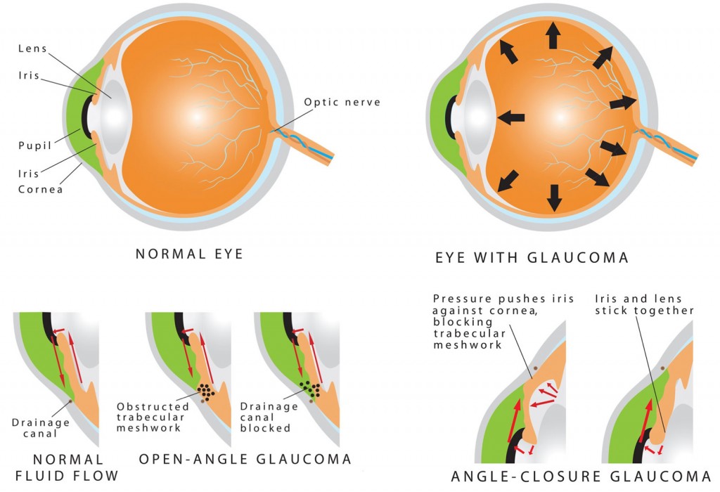 Types of Glaucoma: A Friendly Guide to Eye Health