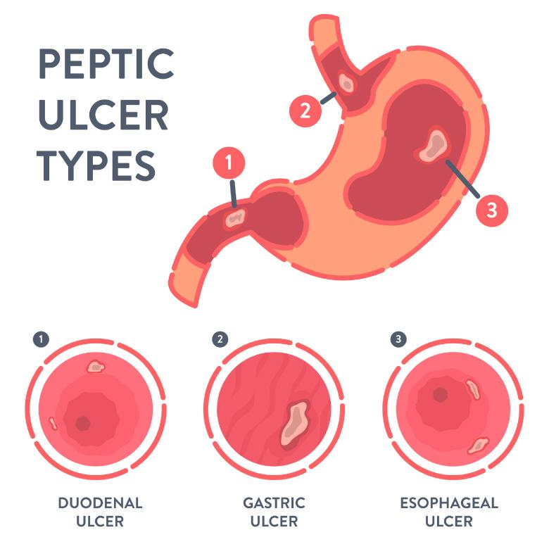 Types of Peptic Ulcer – What You Need to Know Right Now