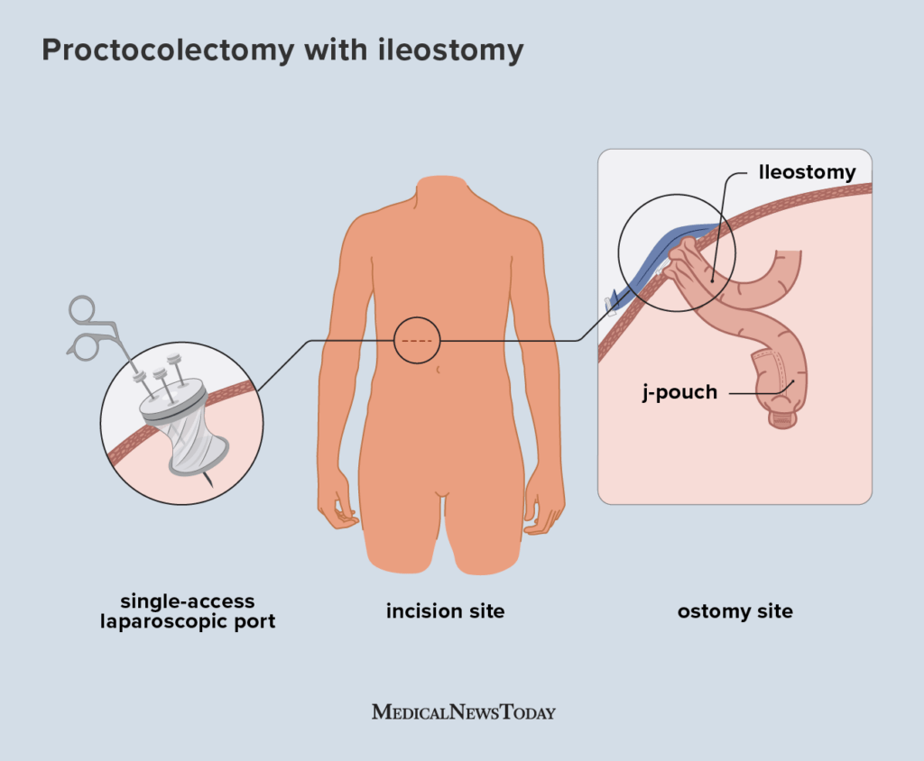 Ulcerative Colitis Surgery: Essential Guide You Need