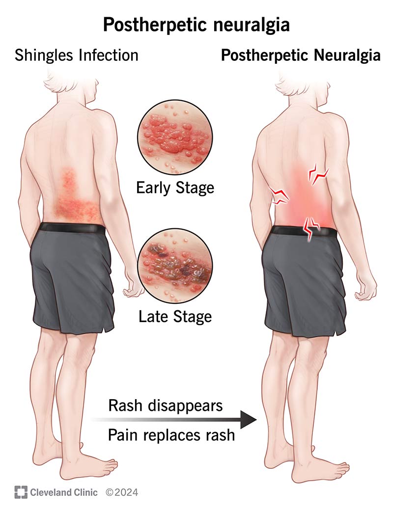 Understanding the Virus That Causes Hip Pain in Adults