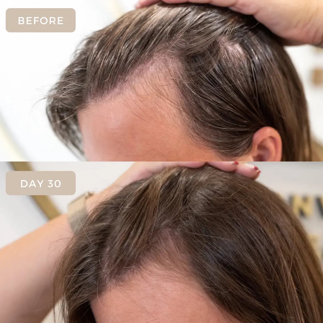 What Does Hair Loss From Stress Look Like? Quick Guide