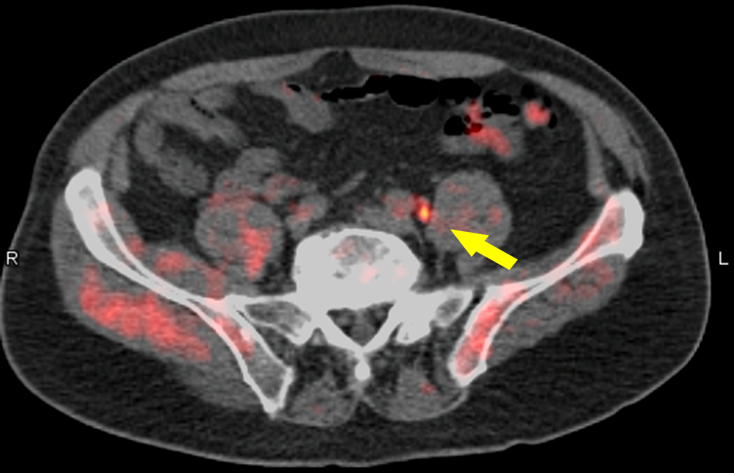 What is the Best Scan for Prostate Cancer? Find Out Now