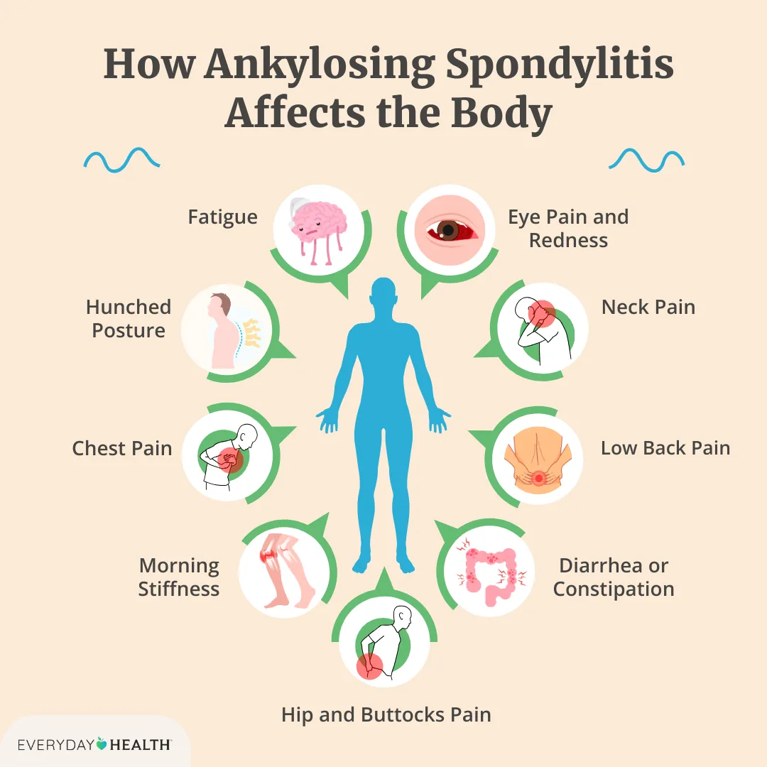 Ankylosing Spondylitis Symptoms Checklist – Key Signs