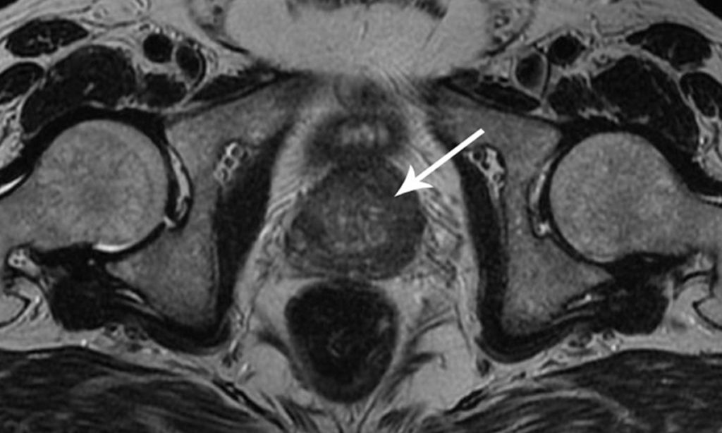 Can MRI miss prostate cancer? What you need to know