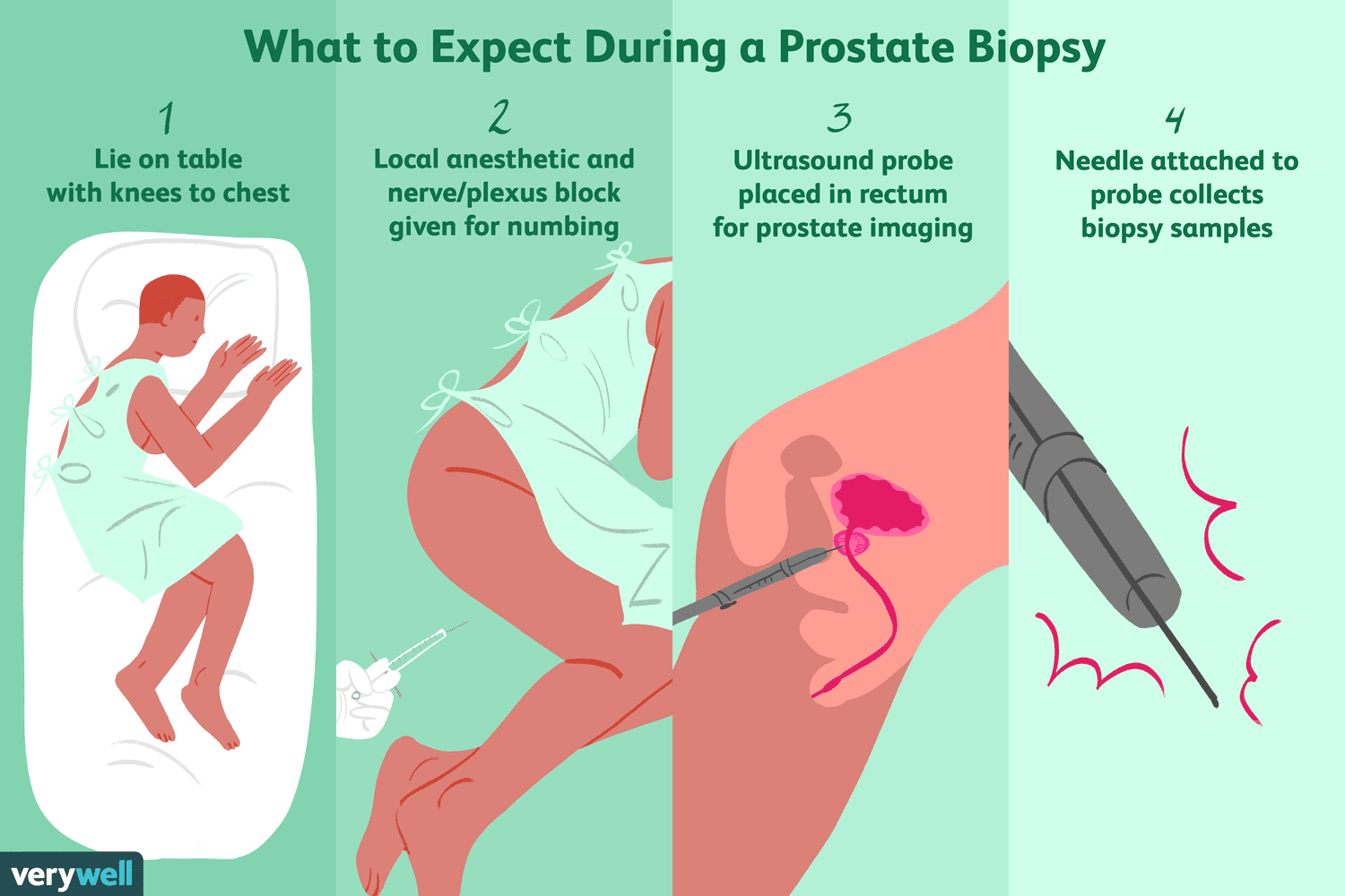 Understanding the Long‑Term Side Effects of Prostate Biopsy