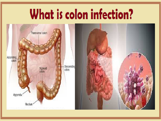 What Causes Bacteria Infection in the Colon? Explained