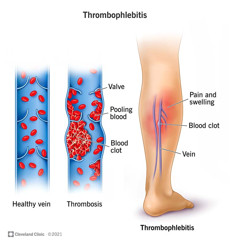 Another Name for Blood Clot in Leg – Quick Guide