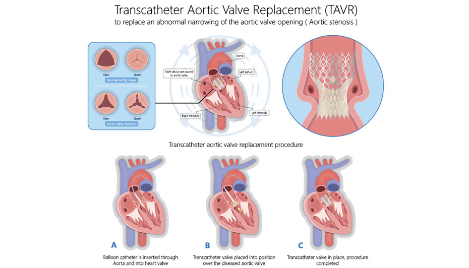 Aortic Valve Replacement ICD-10-PCS Code Explained