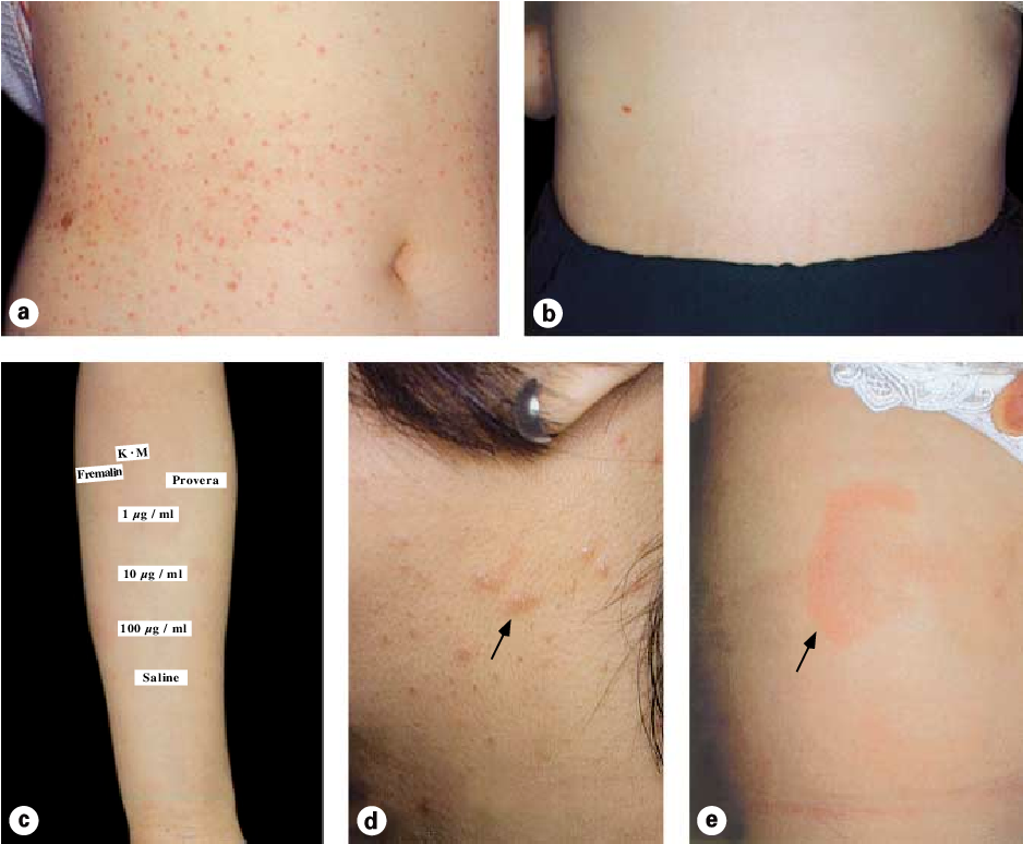 Autoimmune Estrogen Dermatitis: Symptoms and Treatments