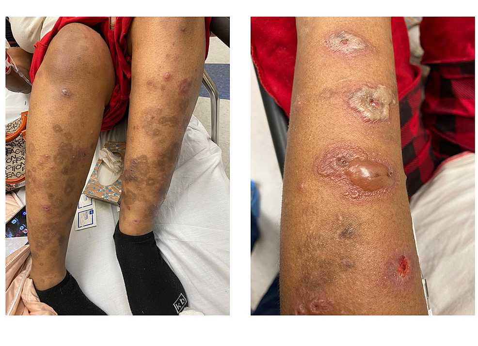 Autoimmune Progesterone Dermatitis Natural Treatment