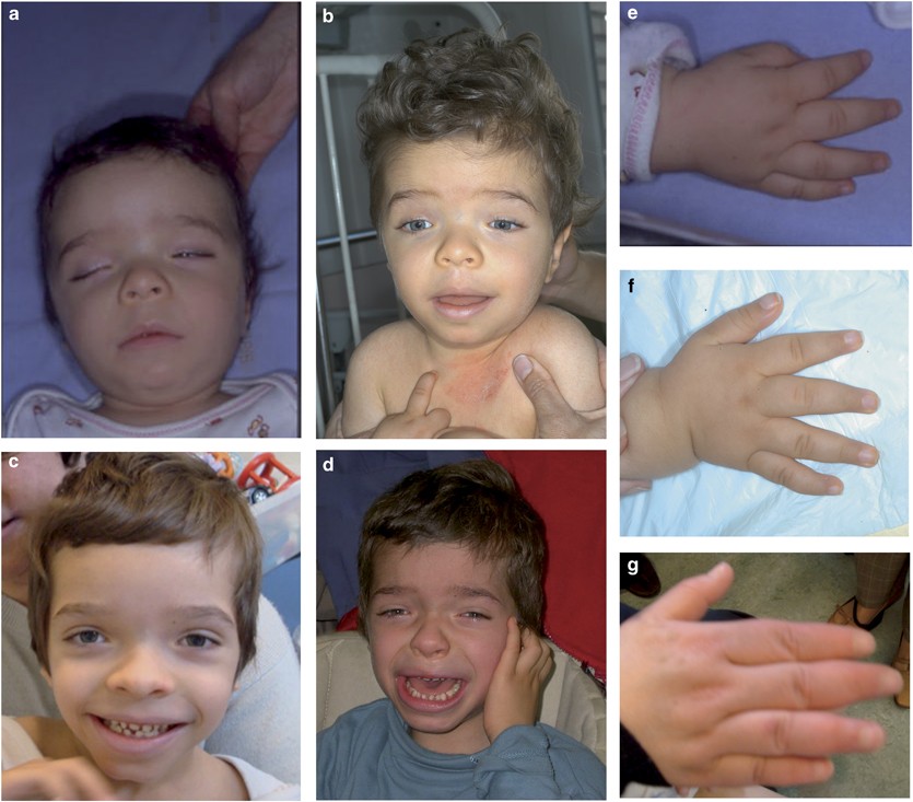 Coffin‑Lowry Syndrome GeneReviews Overview: Your Guide