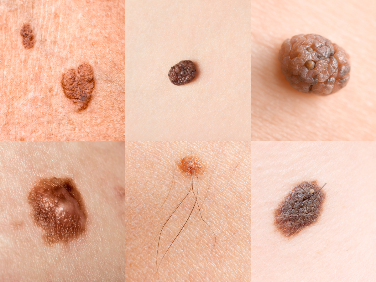 Deadly Skin Cancer Photos: What You Need to Know