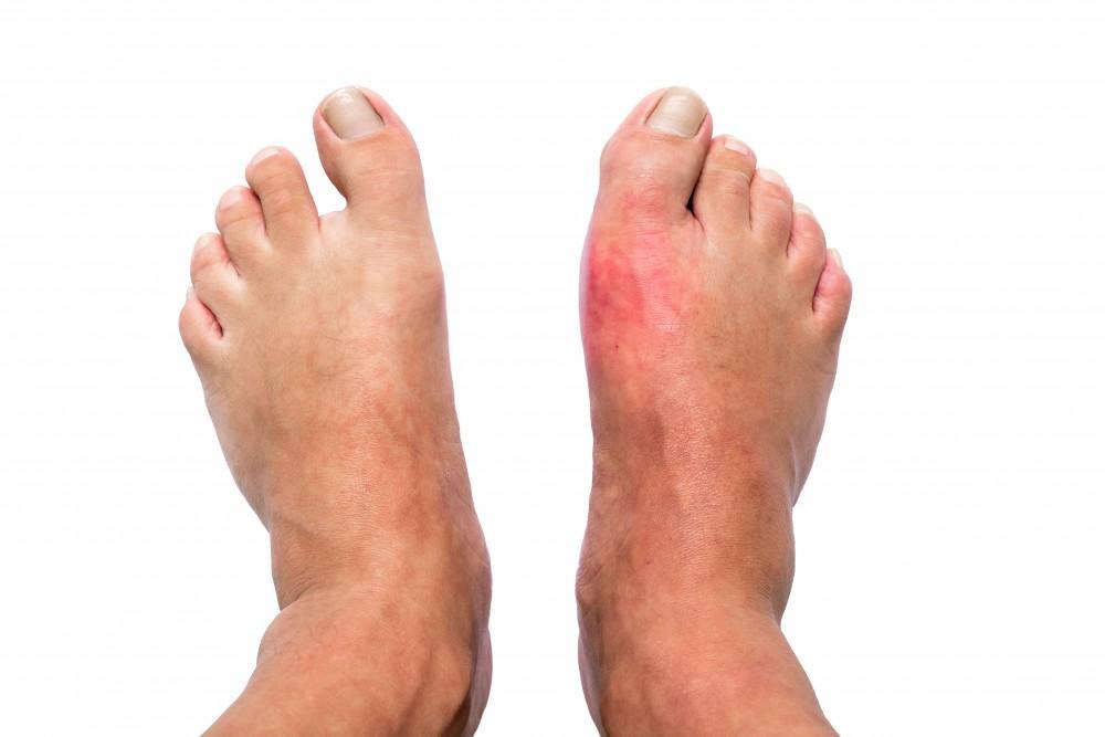 Gout Throbbing Pain: Causes, Symptoms & Quick Relief