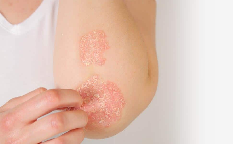 How to Treat Autoimmune Skin Disorders Naturally
