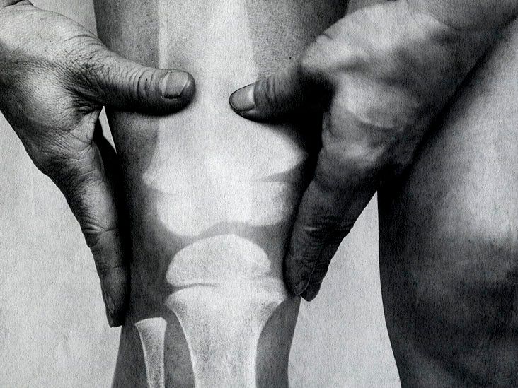 Long-Term Side Effects of Tymlos: What to Know