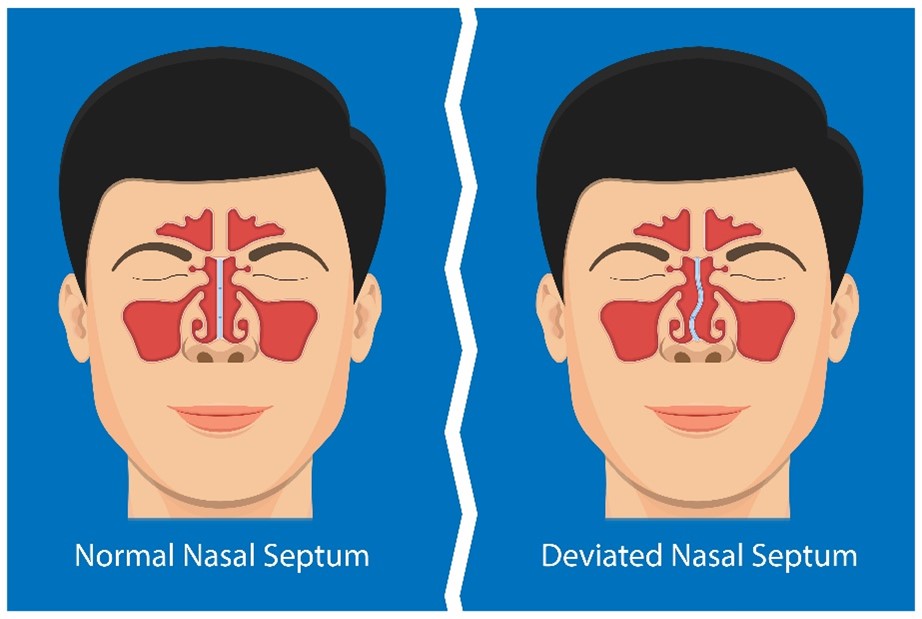 Nose Surgery to Breathe Better Cost: Key Facts