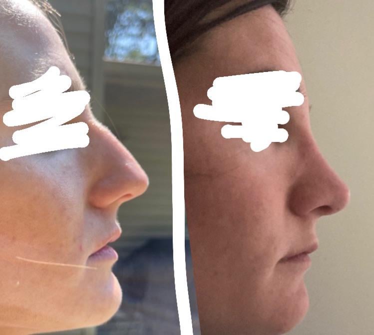Rhinoplasty for Breathing Reddit – Real Stories & Tips