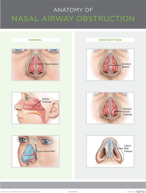 Septoplasty Recovery: Fast‑Track Healing Guide for You