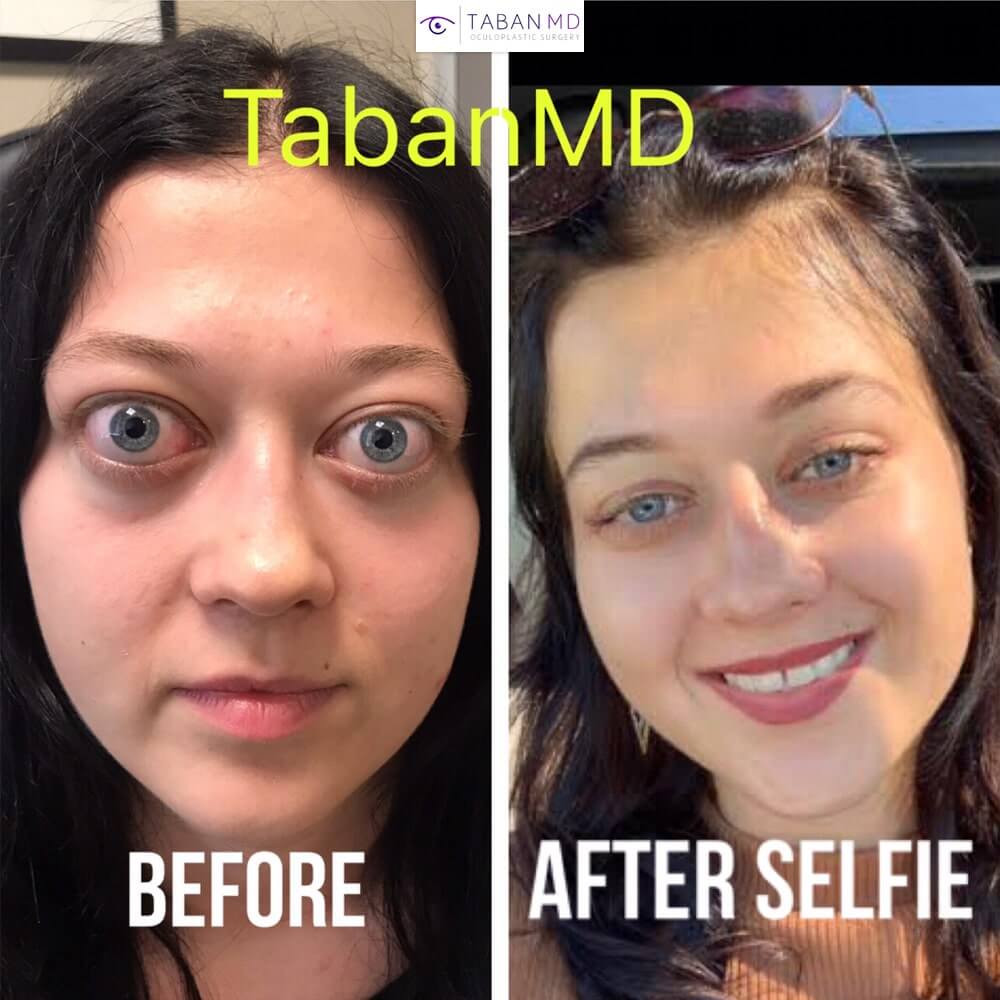 Thyroid Face Before and After: Real Changes Explained