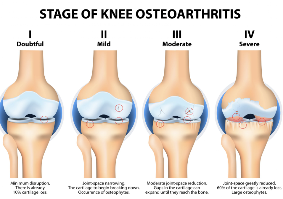 What Are the 4 Stages of Osteoarthritis? A Friendly Guide