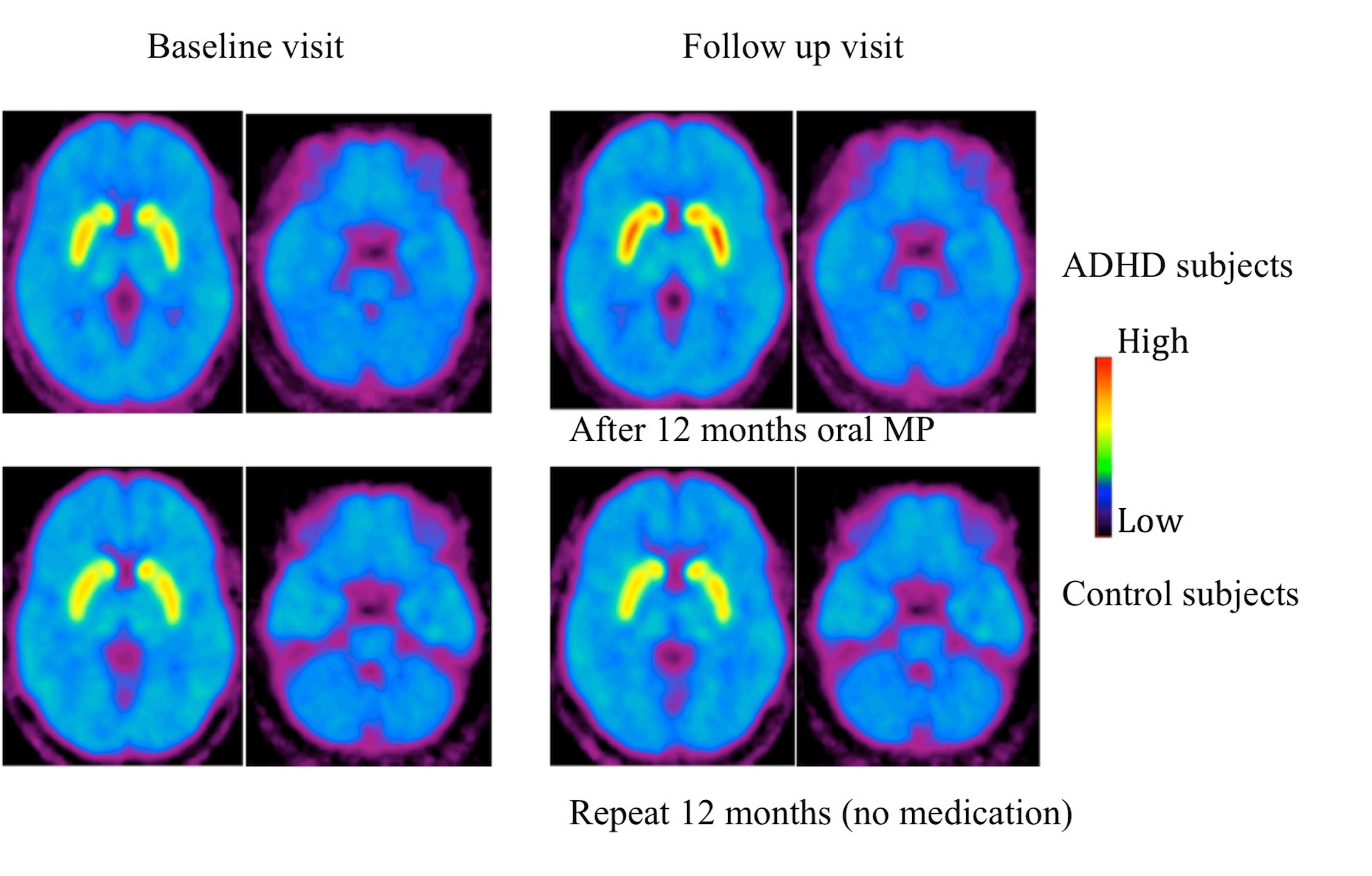ADHD Brain vs Normal Brain Dopamine: What’s Different?