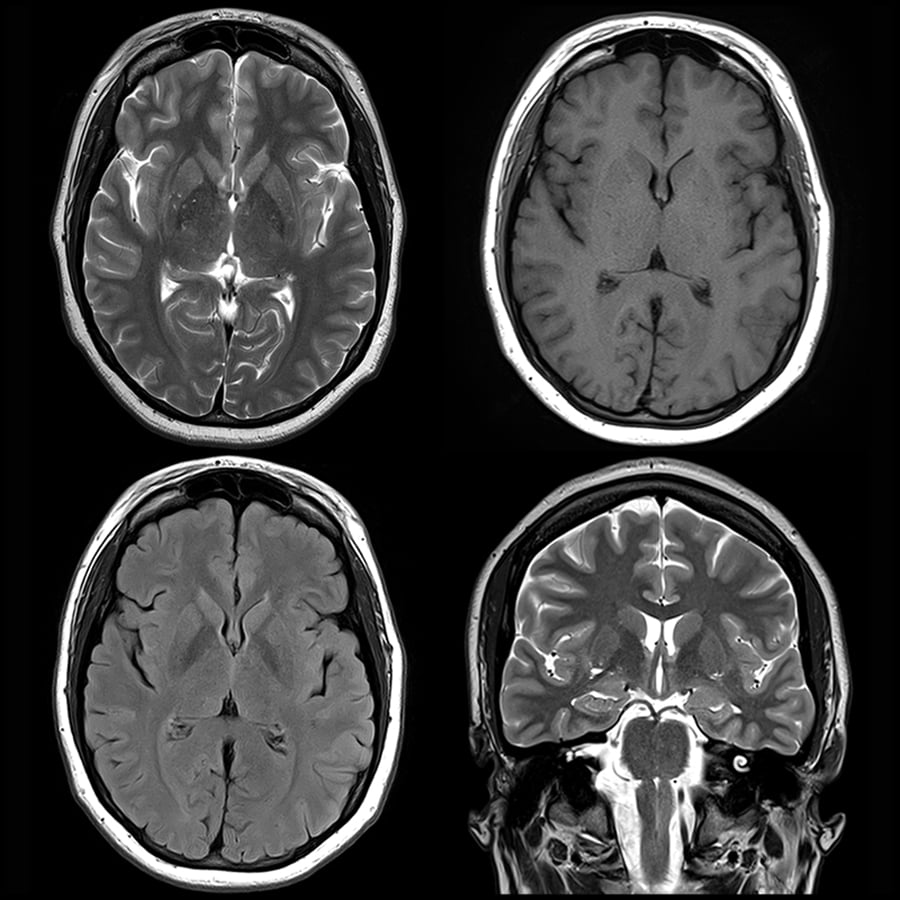 ADHD Brain vs Normal Brain Scan: What the Science Shows
