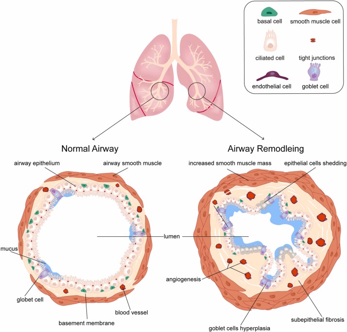 Airway Remodeling in Asthma: Meaning & Management