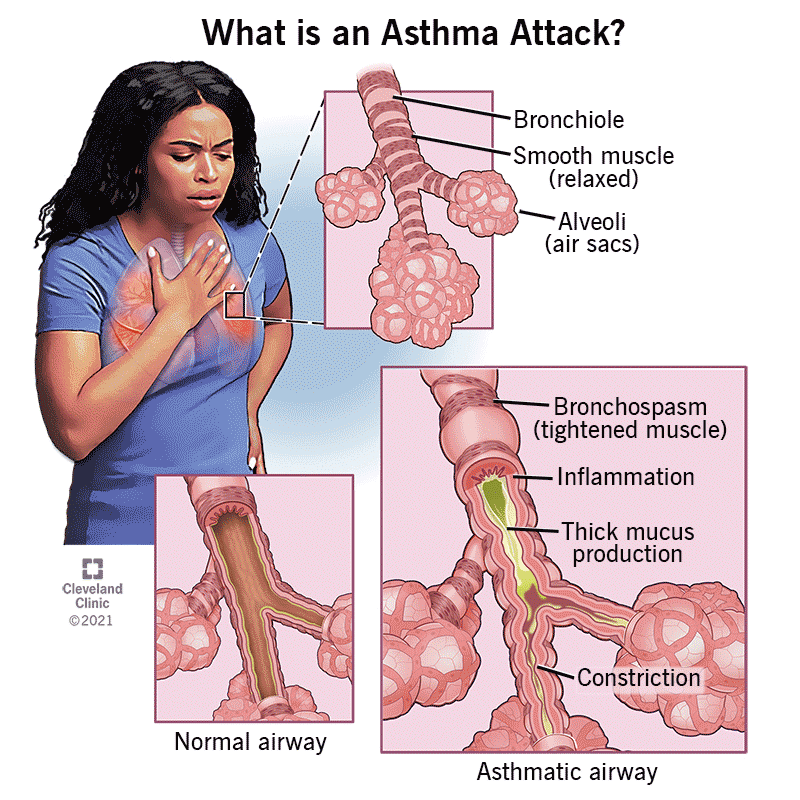Asthma Inflammation Symptoms: What You Need to Know