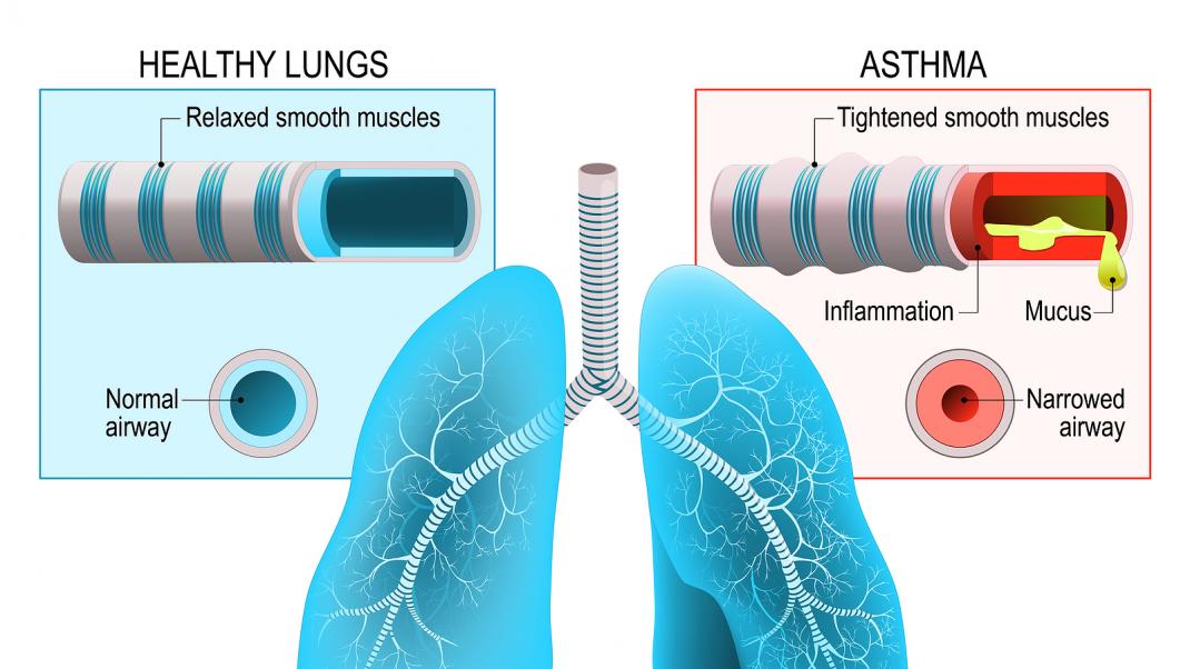 Asthma Lung Scarring Symptoms – What You Need to Know