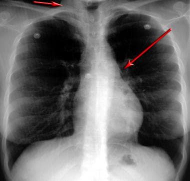 Can You See Asthma on a Chest X‑Ray and What It Means