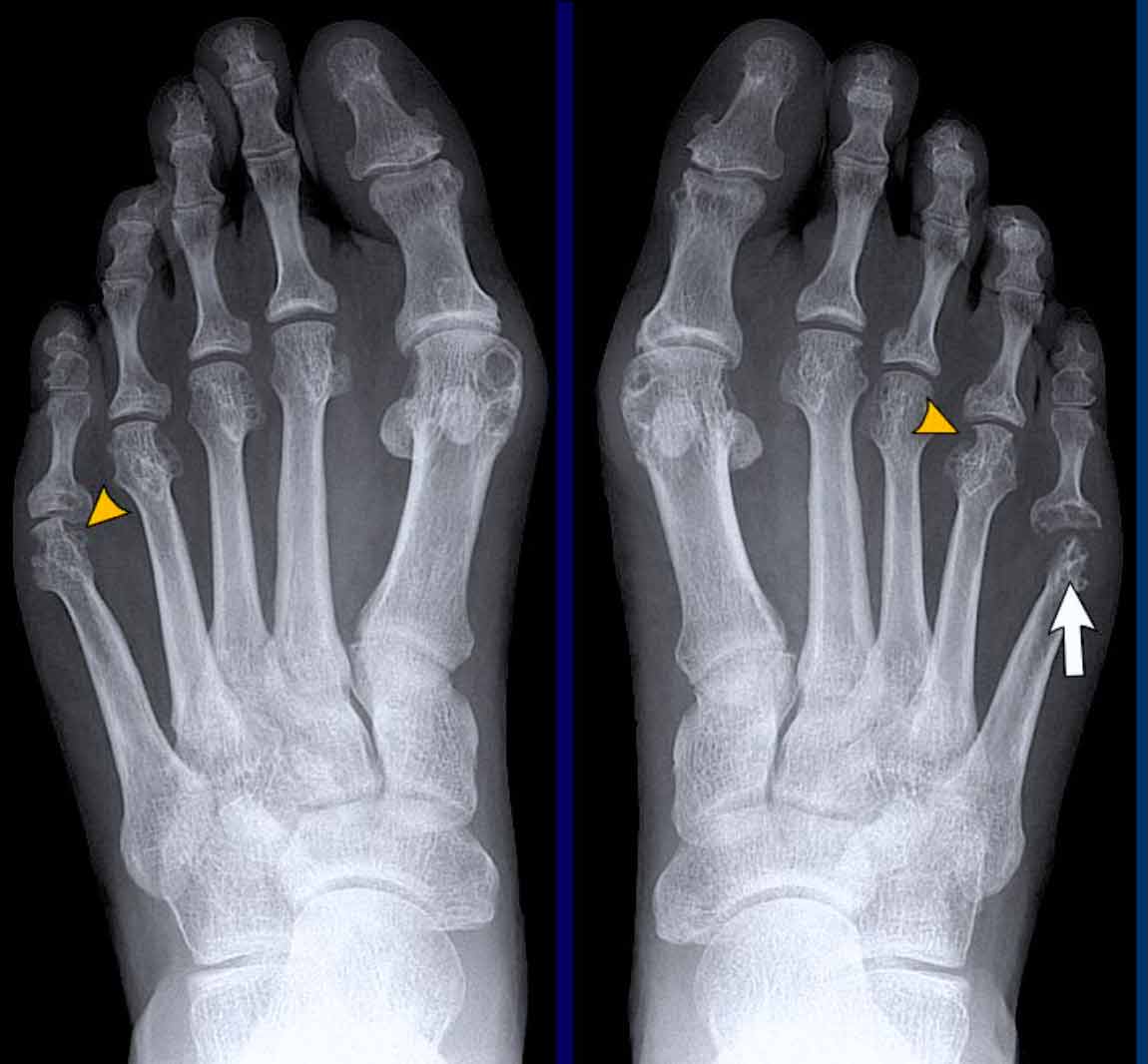 Can you see rheumatoid arthritis on a plain X‑ray?