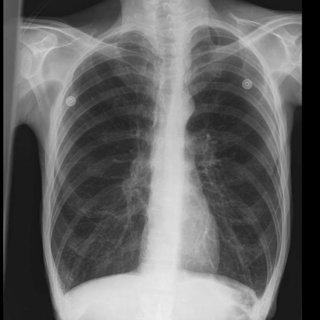 Chest X‑Ray Asthma Hyperinflation: What It Means for You