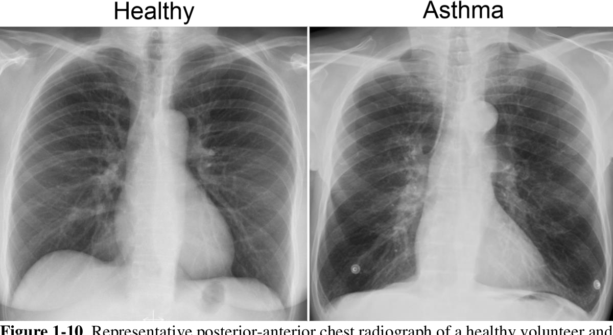 Chest X‑Ray Asthma vs Normal: What to Expect