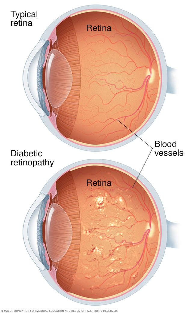 Diabetic Retinopathy: Symptoms, Stages & Treatments